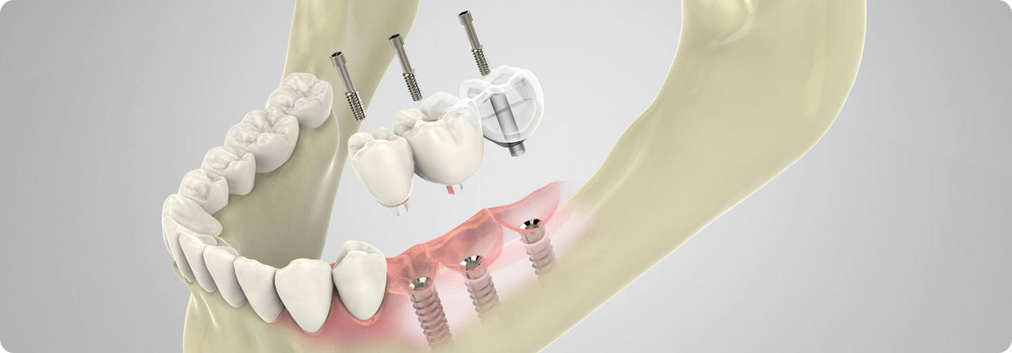 임플란트 재수술 3D 이미지